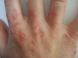Аллергическая сыпь - крапивница | Симптомы | Клиника «Консилиум»