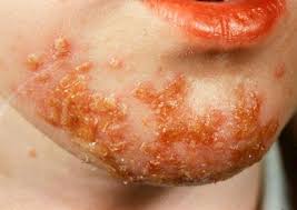Лечение бактериальных инфекций кожи