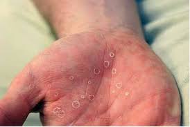 Сифилис - симптомы сифилиса и стадии развития, лечение.